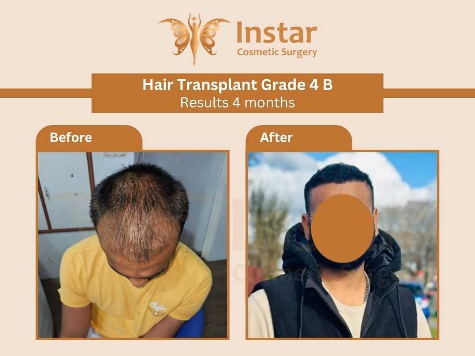 Hair-transplant-grade 4 B results 4 months